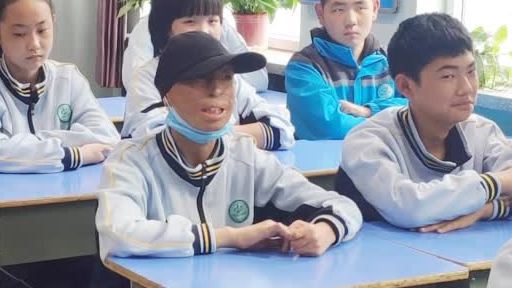 【中国版奇迹男孩!烧伤男孩送礼物感谢师生关心[心]】甘肃兰州,李宽3岁时身体被烧伤90%,