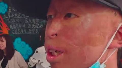 【一个好老师会影响孩子的一生!】甘肃兰州,李宽3岁时身体被烧伤90%,父亲为救治他曾卖头皮