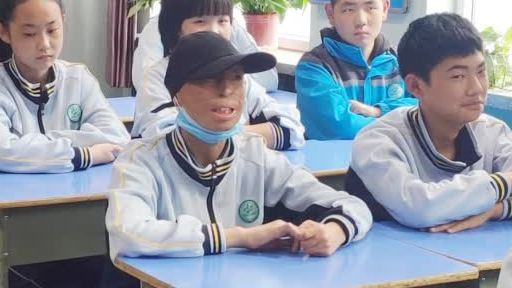 【中国版奇迹男孩!烧伤男孩送礼物感谢师生关心】甘肃兰州的李宽3岁时身体被烧伤90%,父亲为