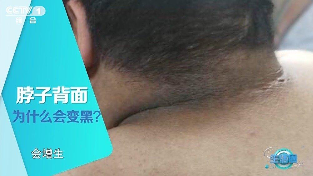 【注意!颈后腋窝等部位变黑可能是癌症征兆】一般情况下,颈后在日晒后出现红斑,随后皮肤变黑可