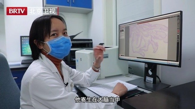 在某位昏迷患者的大脑中,医生取出了一条寄生虫!显微镜下的它到底长什么样子?它又是如何进入大