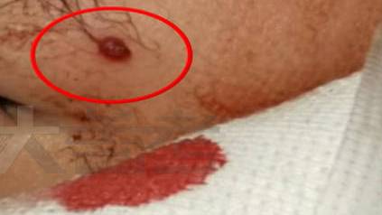 【1岁男孩挠破脸上红包血流不止急救医 医生:这个小红包会持续长大,不会自行消退】近日,郑州