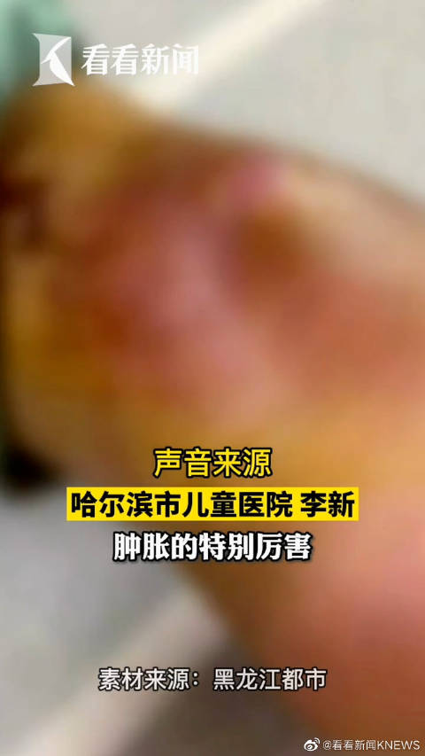 【皮肤红肿发紫!男孩被蚊子叮了一下差点残疾】近日,哈尔滨一名5岁男童的脚踝被蚊子叮咬了一下