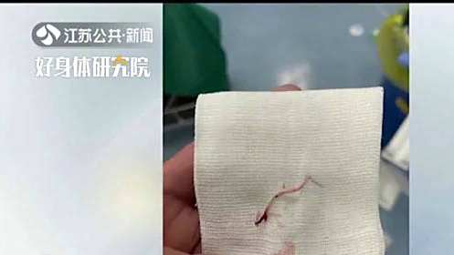 【#南通# 差点没命!女子鱼刺卡喉土法处理刺穿动脉】近日,南通一名52岁女子被一根2厘米长