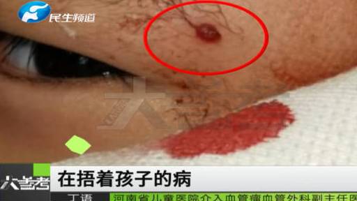 【1岁男孩挠破脸上红包血流不止急救医 医生:这个小红包会持续长大,不会自行消退】近日,郑州
