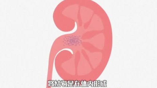 【你的肾是怎么长出“石头”来的?】有过肾结石的人大概不愿回想“排出结石的过程”,有人形容它