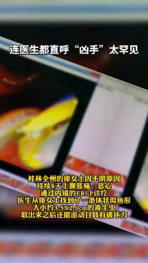 【广西#女子肝脏被寄生虫吃掉三分之一#,或与吃凉拌生鱼腥草有关】近日,广西桂林全州的俸女士