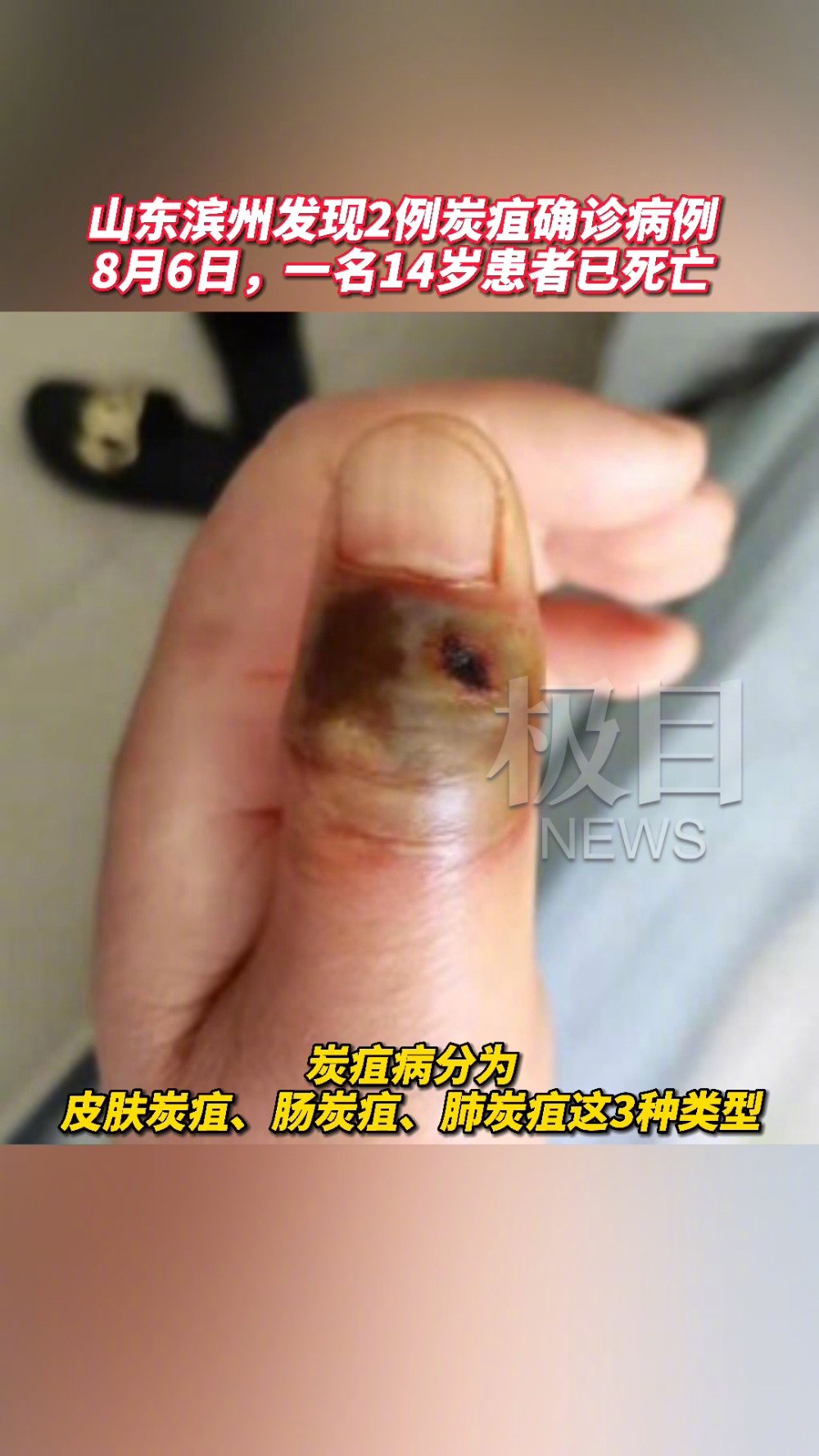 【一个月内全国三地出现炭疽疫情,均为肉牛养殖县】日前,山东省滨州市阳信县出现两例炭疽病确诊