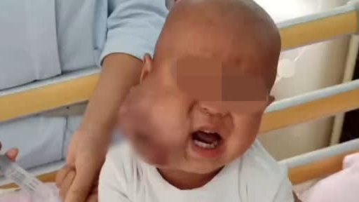 #蓝色生命线#来自贵州六盘水的枚枚从11个月大时就被诊断患有横纹肌肉瘤,面部肿瘤一度长到拳