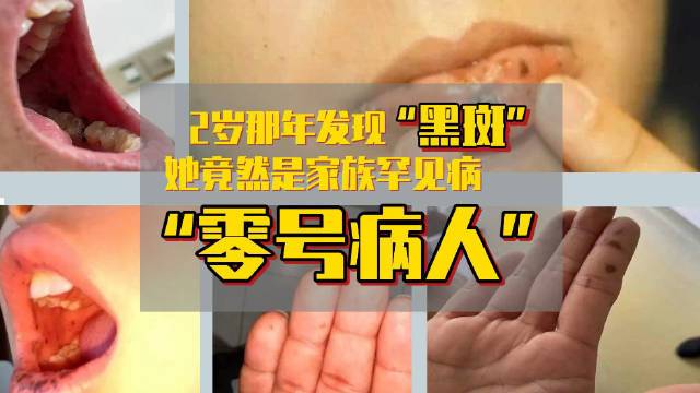 【#女子2岁出现黑斑息肉摘了又长#28岁才被确诊】“2岁起,父母就发现我的嘴唇和手指尖有明