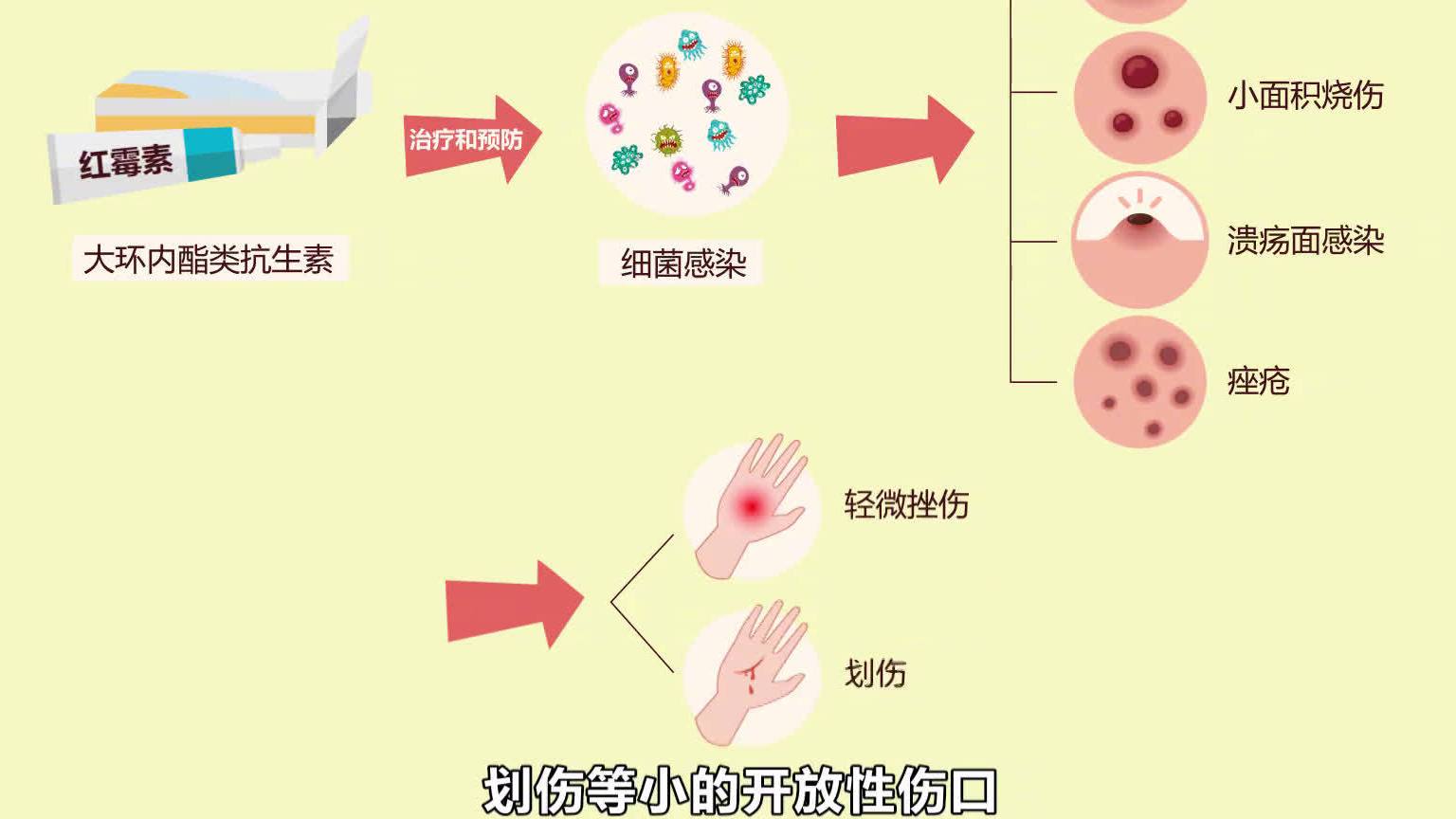 【伤口可以涂红霉素吗?】红霉素有消炎抗菌的作用,又很容易得到,所以有些人出现伤口之后,就赶