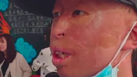 【中国版奇迹男孩!烧伤男孩送礼物感谢师生关心】甘肃兰州,李宽3岁时身体被烧伤90%,父亲为
