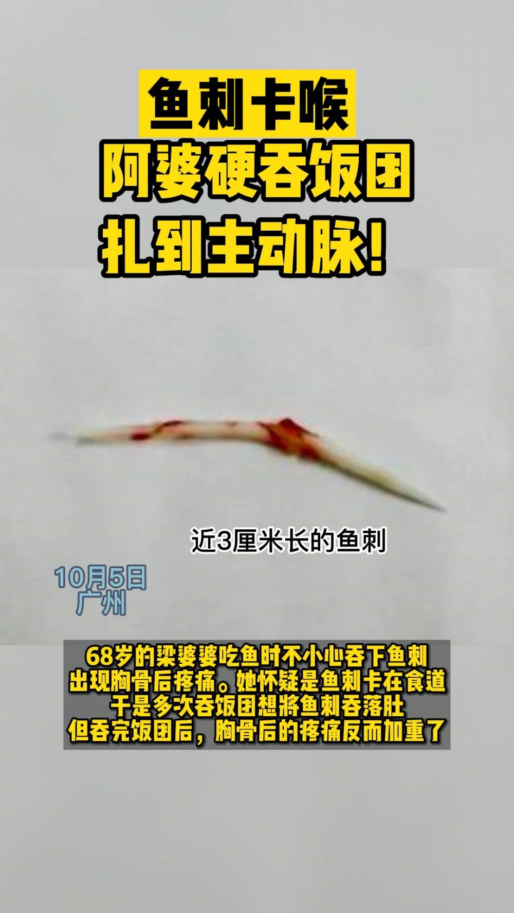 【吃鱼要小心!医生:鱼刺卡喉后“土法”不可取】10月5日,广州68岁的梁女士吃饭时鱼刺卡喉