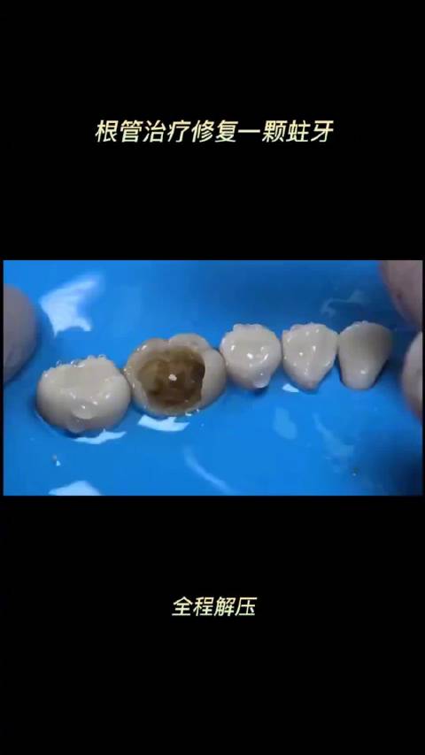 根管治疗修复一颗蛀牙过程 