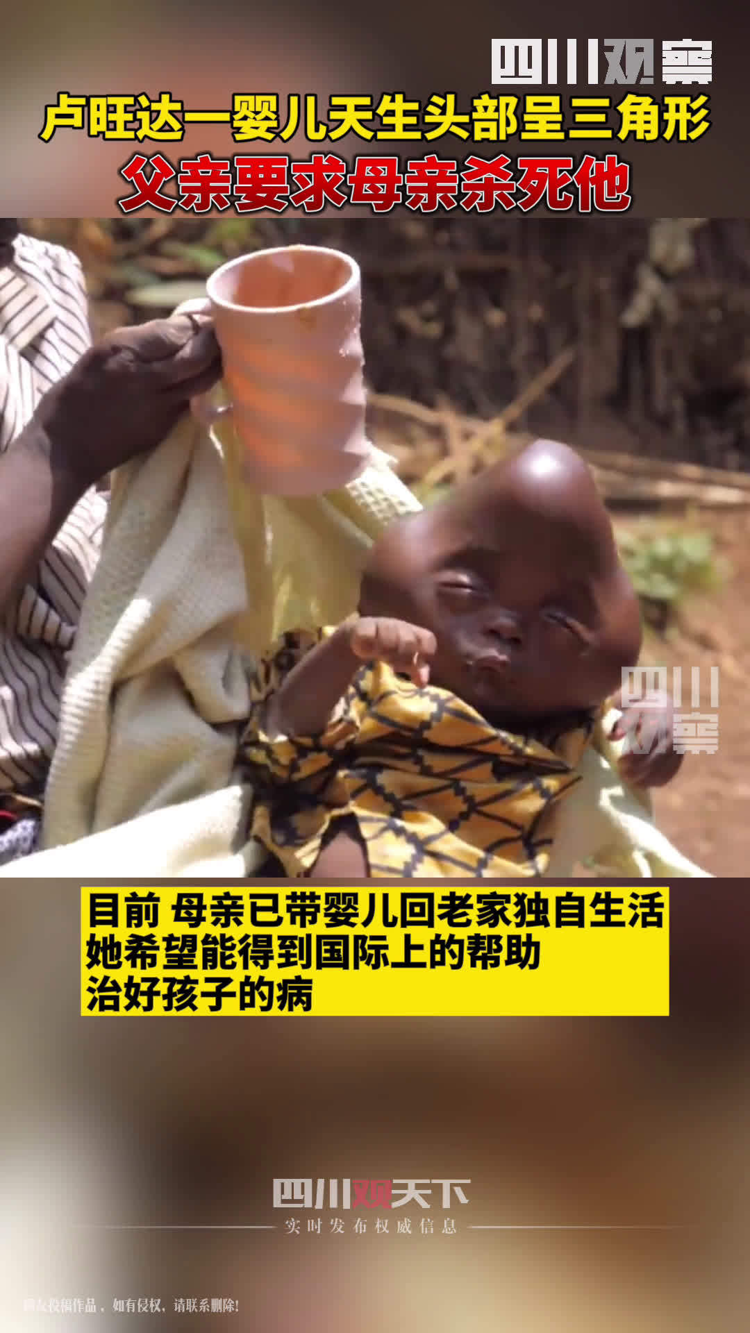 【卢旺达一婴儿头部天生呈三角形 父亲要求母亲杀死他】近日,卢旺达女子Bajeneza因生下