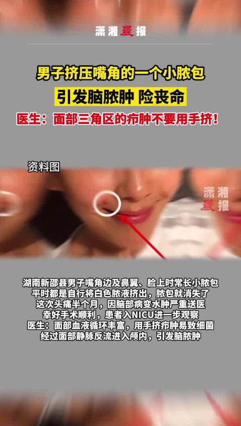 【男子挤嘴角脓包引发脑脓肿险丧命[惊哭]】 湖南邵阳一男子嘴角边及鼻翼脸上时常长小脓包,平