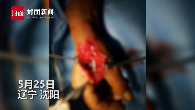 【沈阳一男子河边射鱼反将自己右手射穿 :不玩了,一条鱼没射到】5月25日,辽宁沈阳。一男子