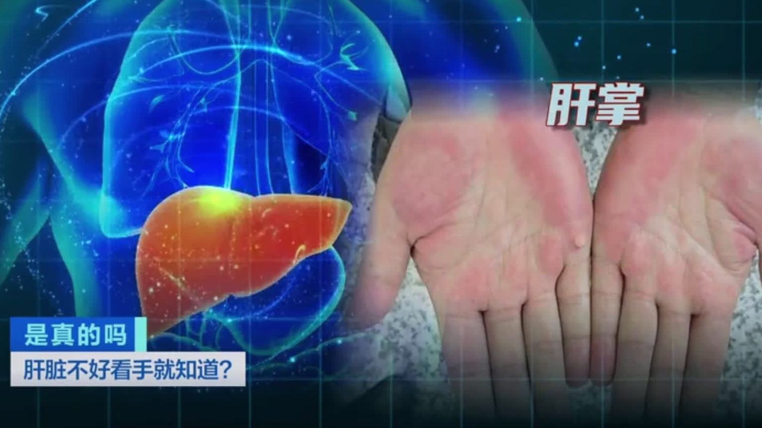 【肝脏好不好 看手就知道?】#男子相亲被女方父亲发现有肝病# 当身体出现肝区疼痛、厌食油腻