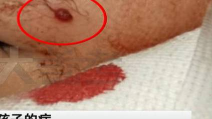 【1岁男孩挠破脸上红包血流不止急救医 医生:这个小红包会持续长大,不会自行消退】近日,郑州