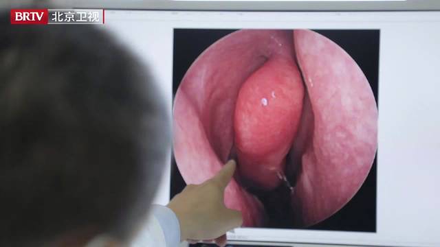 大部分慢性鼻病是自身免疫问题造成,治疗难度很高,在这其中尤其以鼻息肉最为难治,即便使用手术
